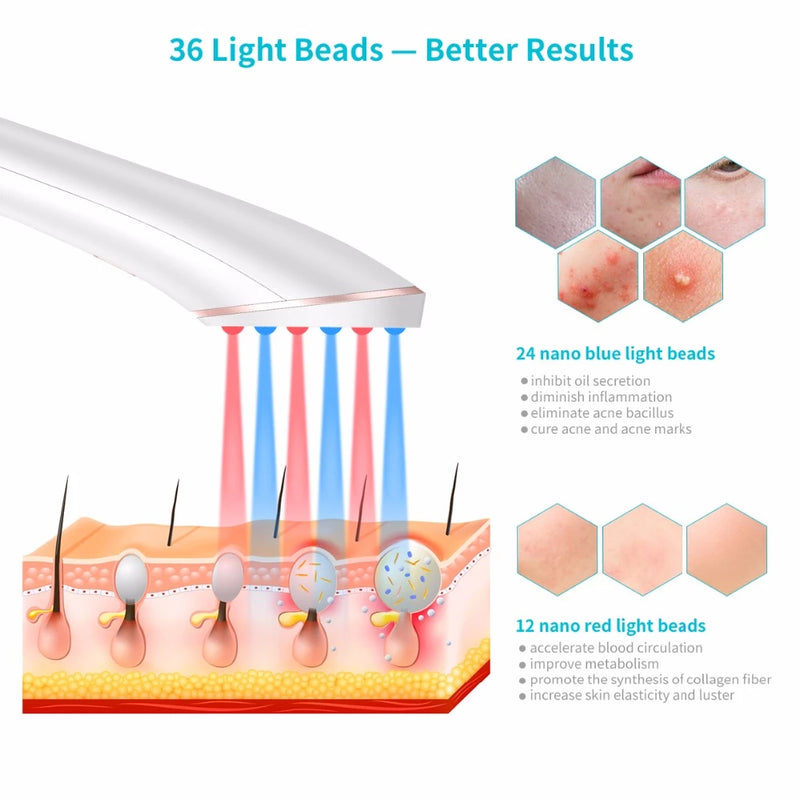 Tratamiento del Acné con Luz Azul y Roja Vexa — uso sobre el rostro
